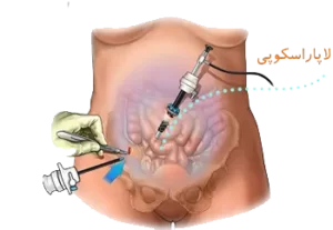 دکتر کیوان مهدی نژاد متخصص لاپاراسکوپی,لیپوساکشن,لاپاراسکوپی,