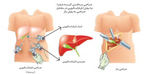 دکتر کیوان مهدی نژاد متخصص لاپاراسکوپی,لیپوساکشن,لاپاراسکوپی,